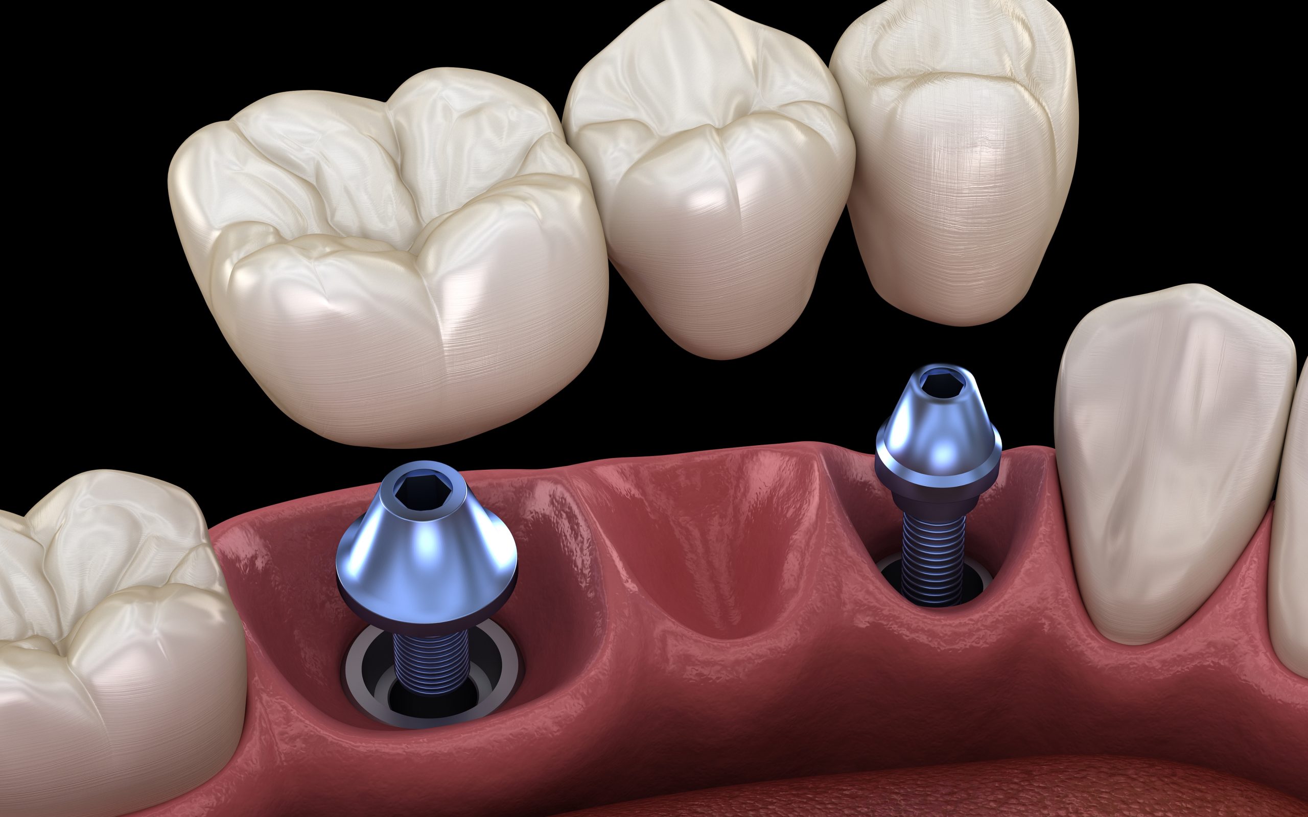 Ceramic peening beads: efficient surface strengthening