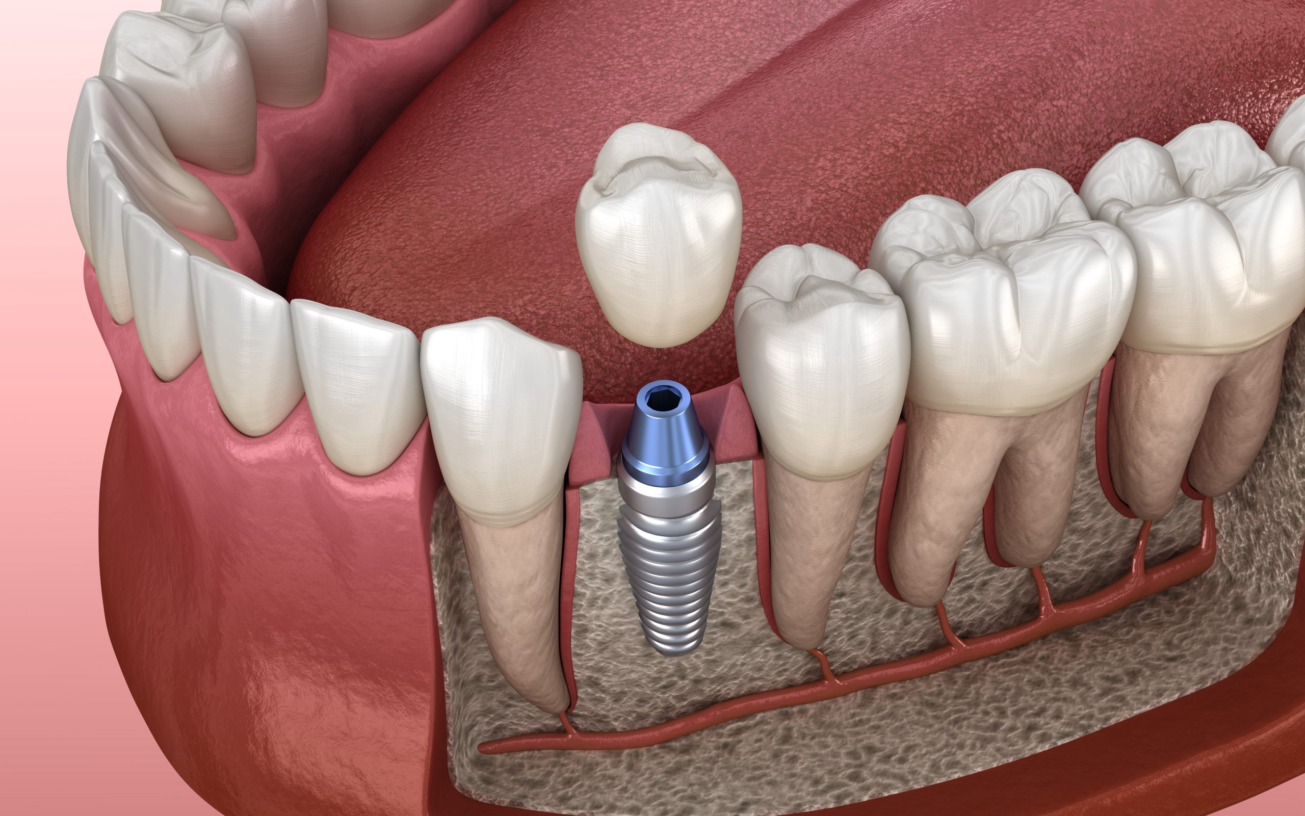 Comment les billes de zircone améliorent la stabilité et la longévité des implants